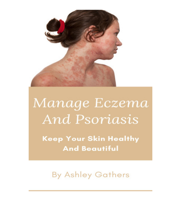 Manage Eczema And Psoriasis